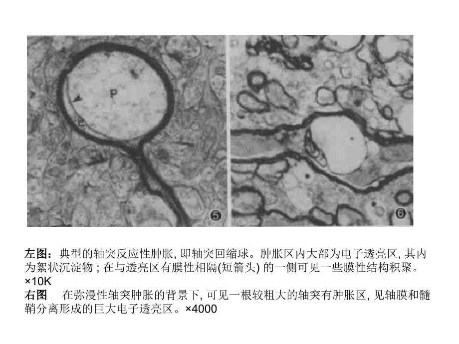 弥漫性轴索损伤（DAI）医学教学培训课件_第5页