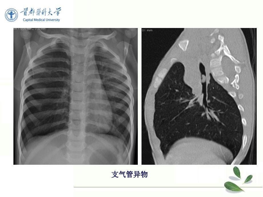 《医学影像技术学》教学课件：呼吸系统第三节 呼吸系统基本病变_第5页