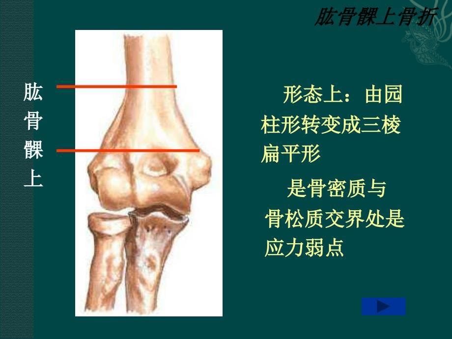 肱骨髁上骨折ppt课件_第5页