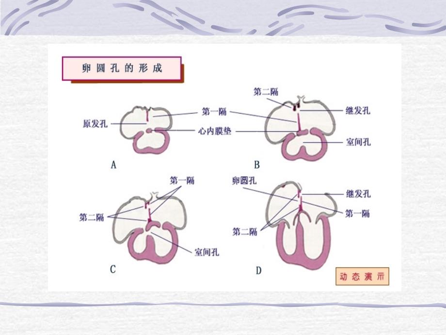 先天性心脏病chd总论及房缺ppt课件_第4页