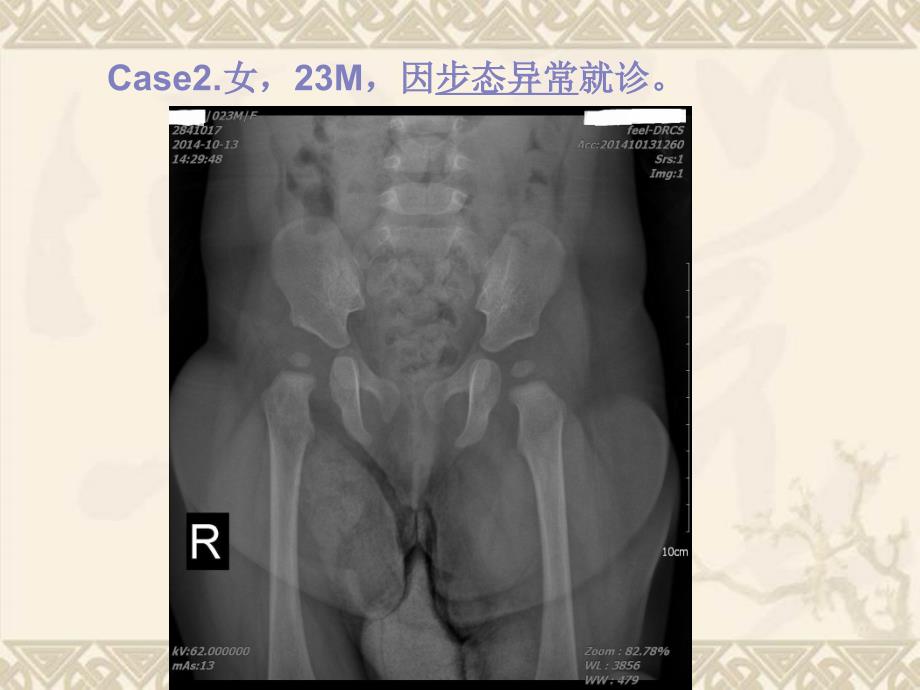 DDH发育性髋关节脱位_第2页