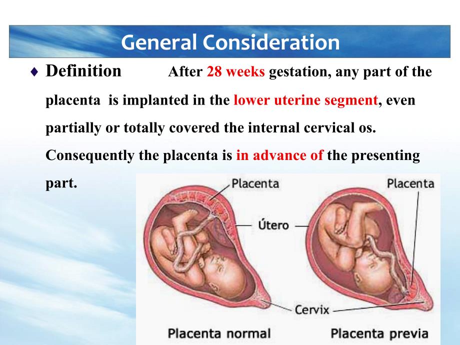 妇产科学教学课件：Placenta Previa_第4页