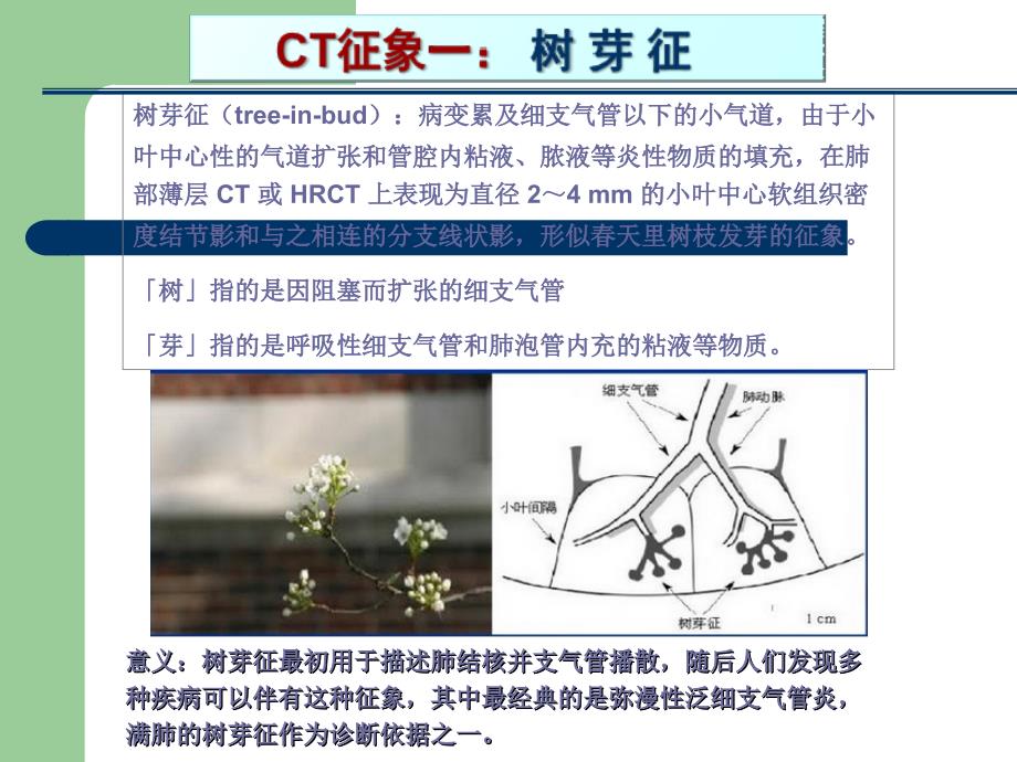 肺部CT十大征象诊断应用40173.ppt_第2页