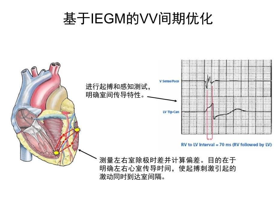 心脏起搏器培训资料：CRT-P Competitors Product_第5页