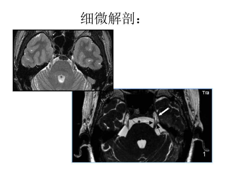 各条颅神经清晰MRI影像3_第3页