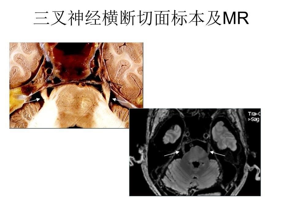 各条颅神经清晰MRI影像3_第5页