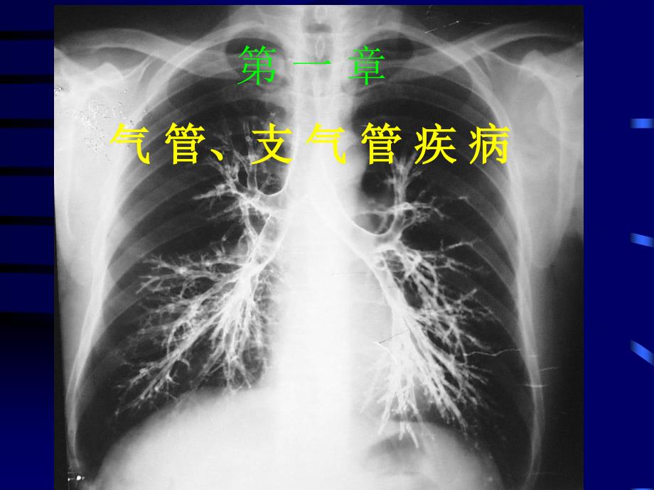 先天性支气管肺囊肿_第2页