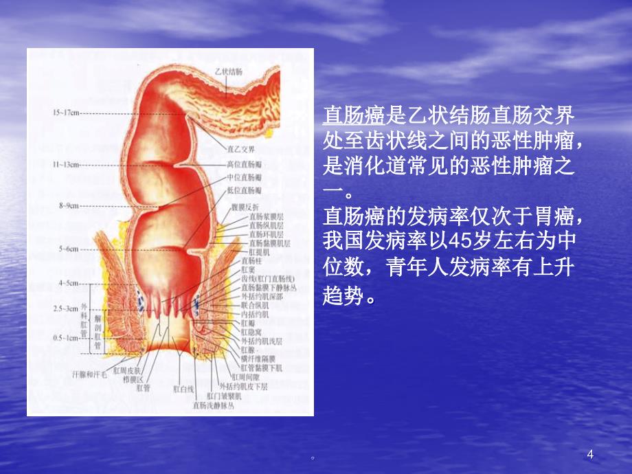 直肠癌术后护理查房.ppt_第4页