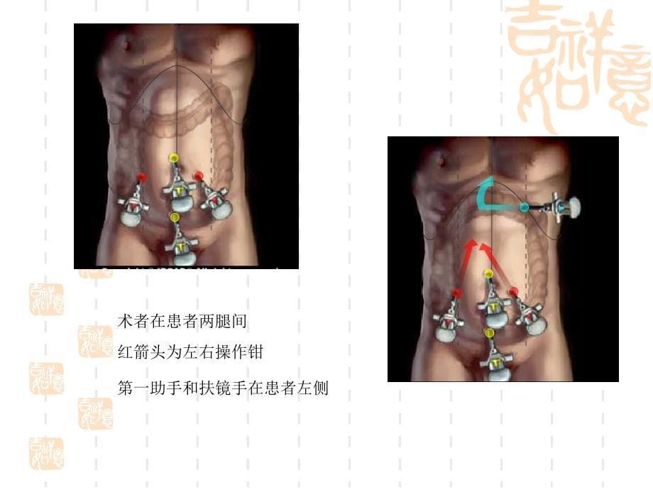 腹腔镜结肠切除术的入路问题_第5页