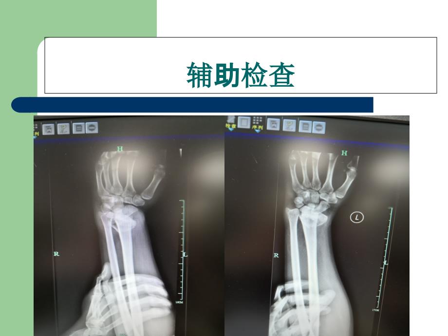 桡骨远端骨折-教学查房_第4页