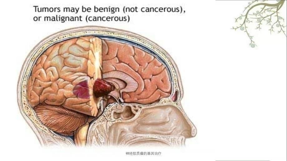 神经胶质瘤的基因治疗课件_第5页