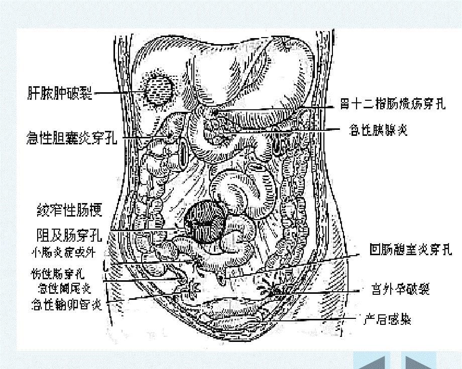 外科护理学外科急腹症病人的护理课件_第5页