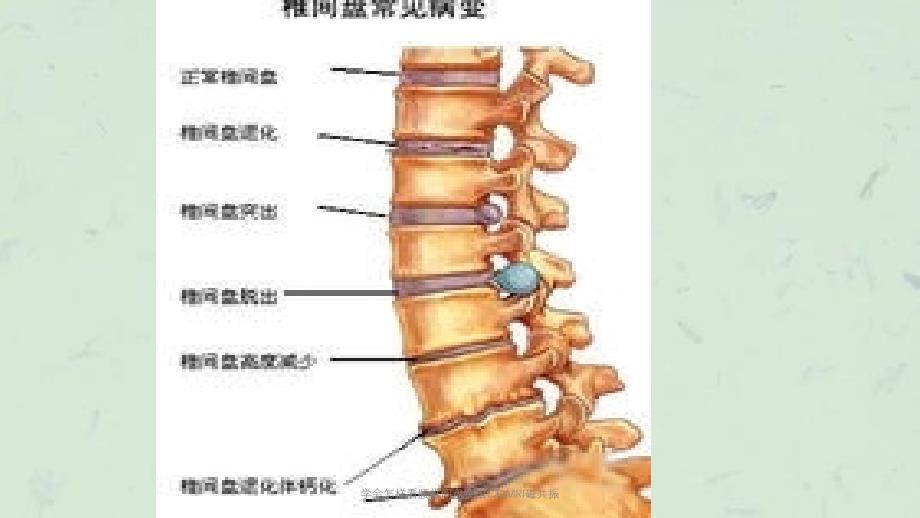 学会怎样看腰椎间盘突出C和MRI磁共振课件_第2页