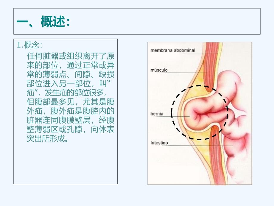 腹外疝医学课件_第3页