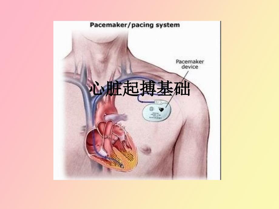 心脏起搏基础_第1页