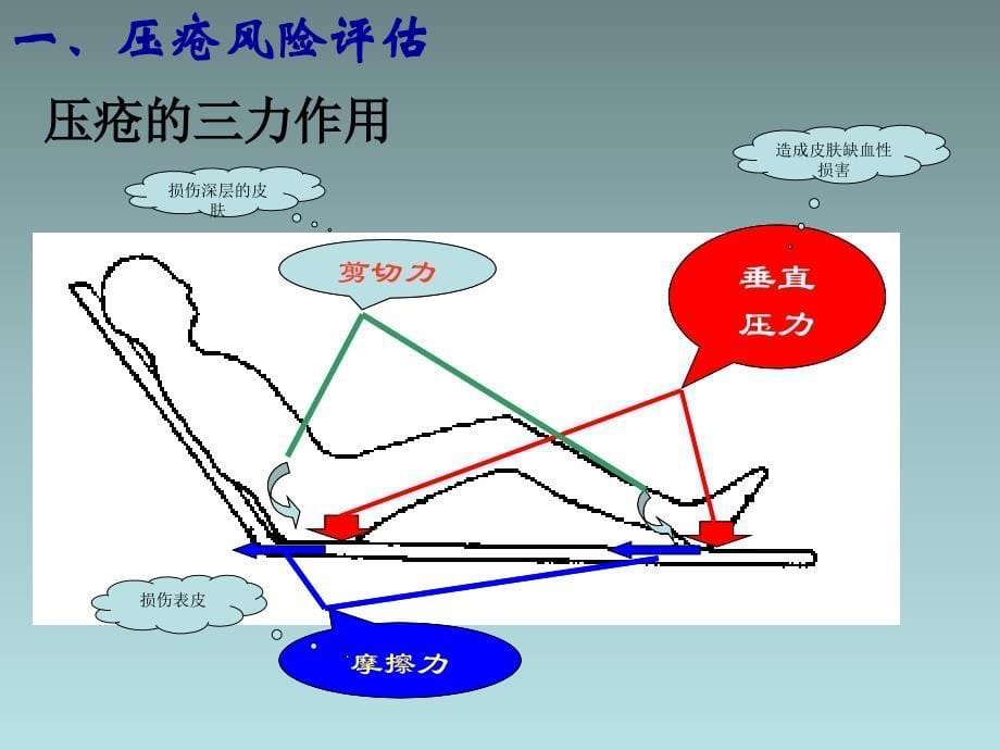 危重患者常见护理风险评估与营养支持_第5页