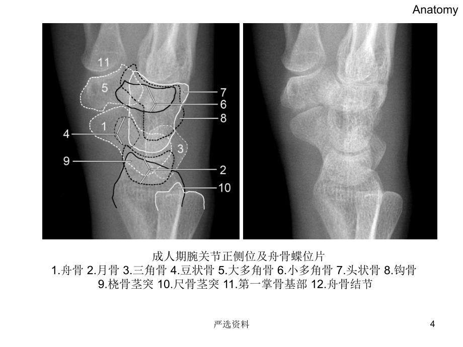 腕关节-X线解剖（行业荟萃）_第4页