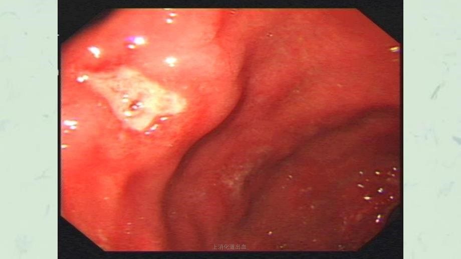 上消化道出血课件_第5页