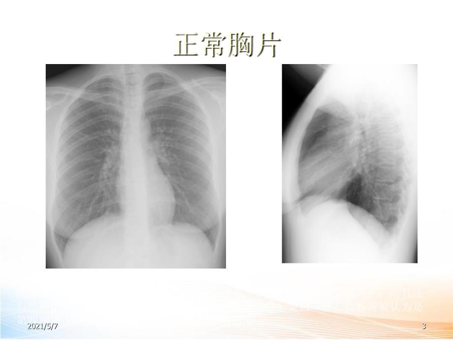 胸片入门 不错 有胃管、深静脉的看法_第3页