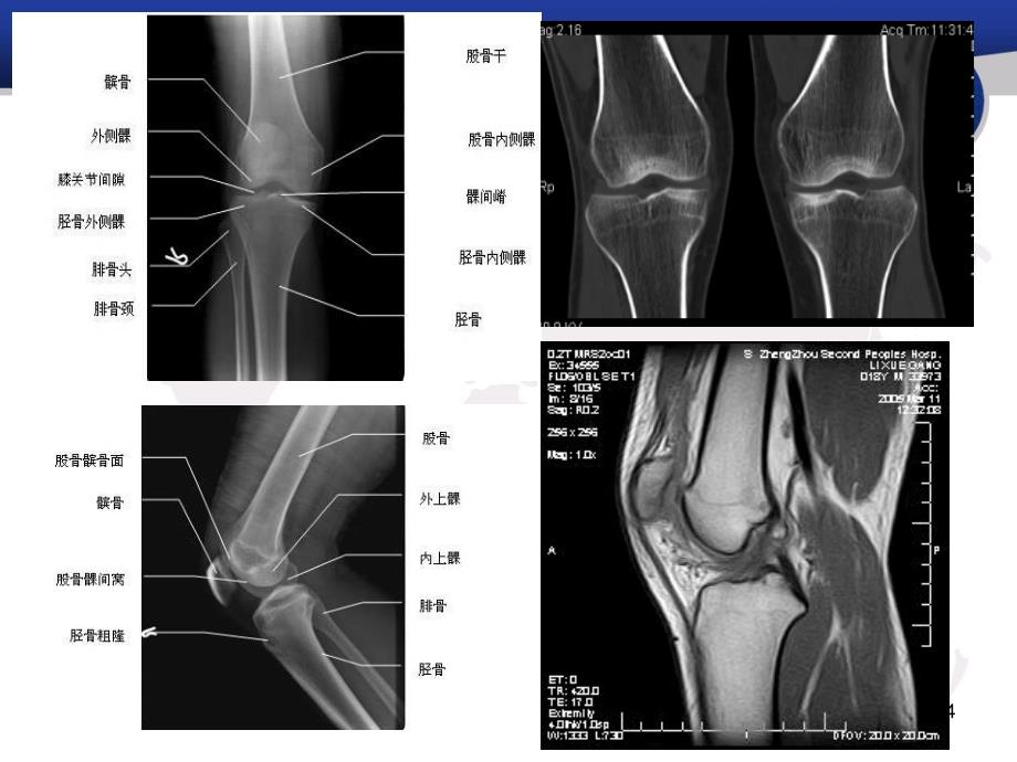 膝关节解剖和常见疾病MRIPPT课件.ppt_第4页