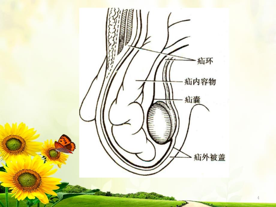 腹股沟疝护理查房PPT参考幻灯片_第4页