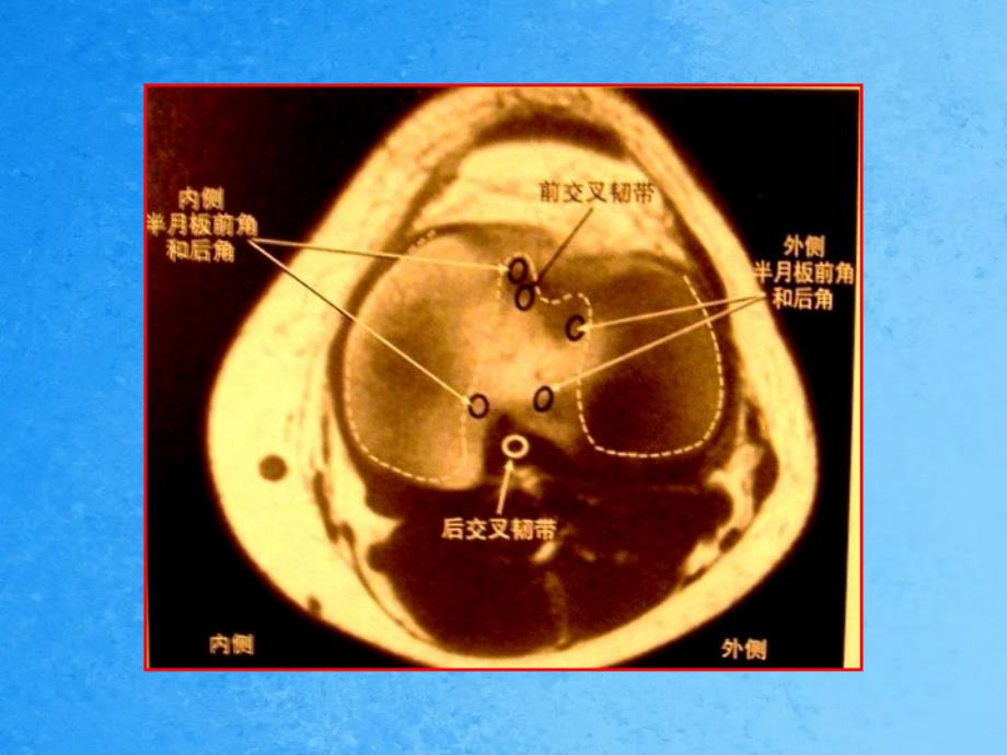 半月板损伤的磁共振表现ppt课件_第3页