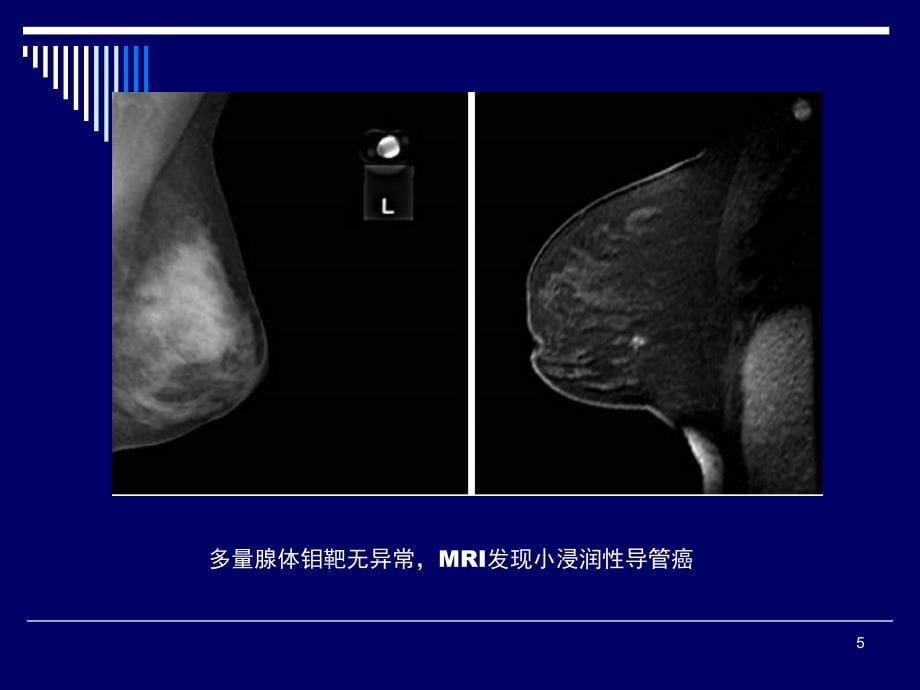 乳腺疾病的MRI诊断及鉴别诊断PPT课件_第5页