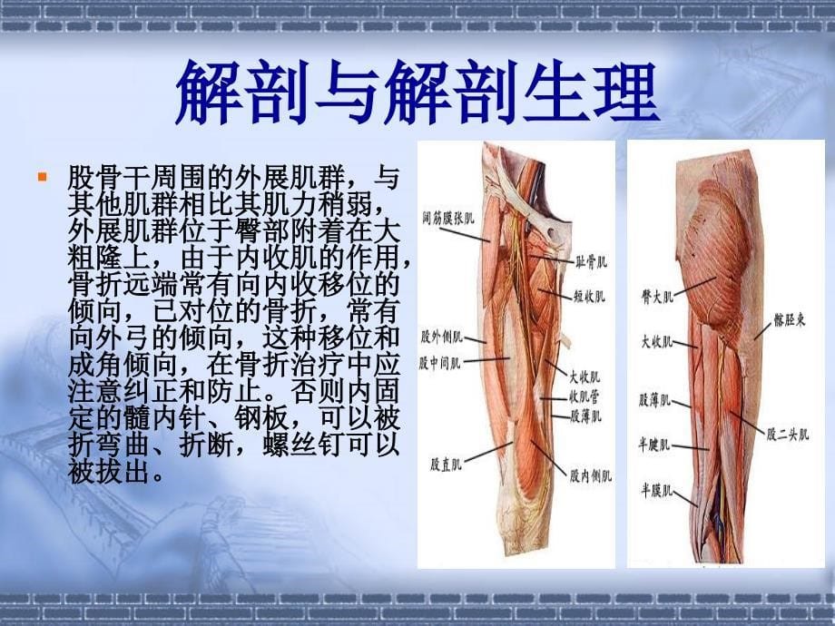 股骨干骨折课件_第5页