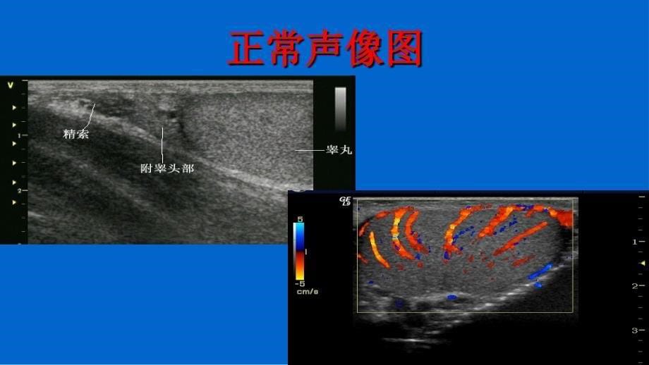 阴囊疾病超声诊断_第5页