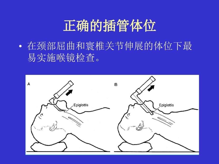 《气管插管及困难》PPT课件_第3页