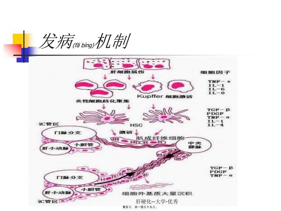 肝硬化--大学-优秀课件_第5页