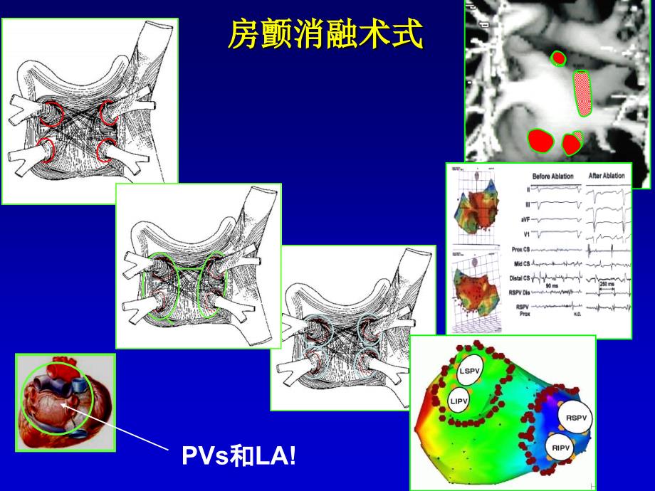 房颤消融后诱发试验：方法及意义王祖禄_第2页