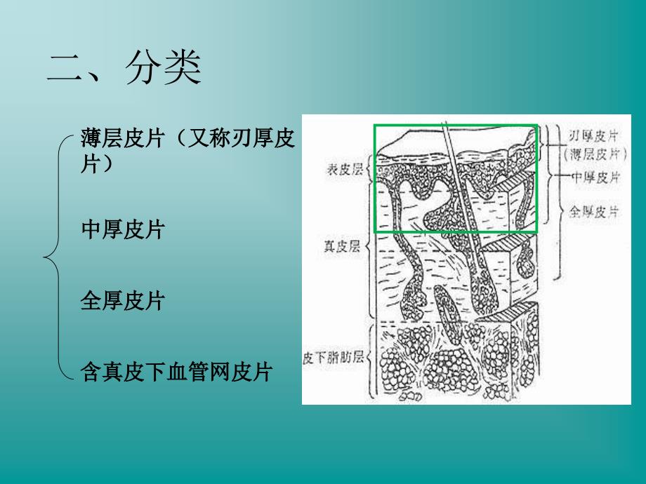 游离皮片植皮术浅谈_第4页