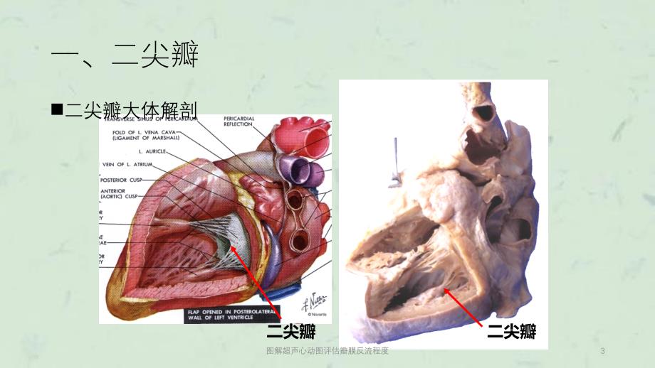 图解超声心动图评估瓣膜反流程度课件_第3页