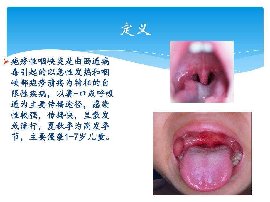 疱疹性咽峡炎[1]_第2页