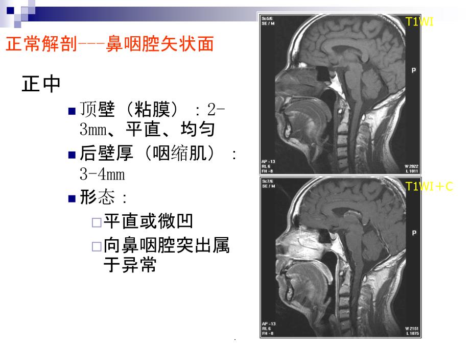 正常颈部解剖_第1页