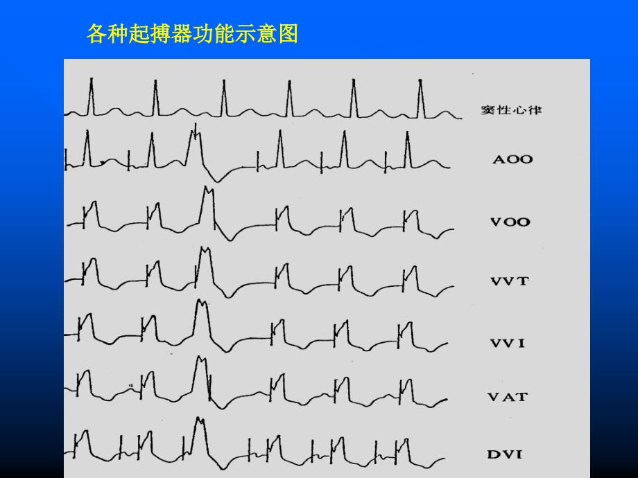 人工心脏起搏、心脏电复律和心血管病介入性治疗_第4页