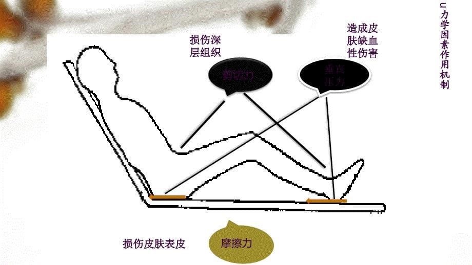 压力性损伤的预防ppt课件_第5页