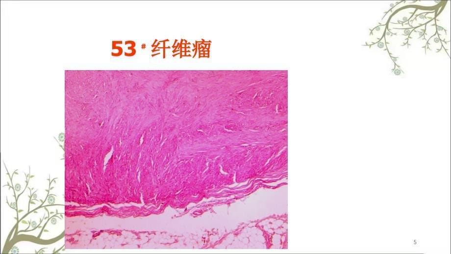 病理学肿瘤2课件_第5页