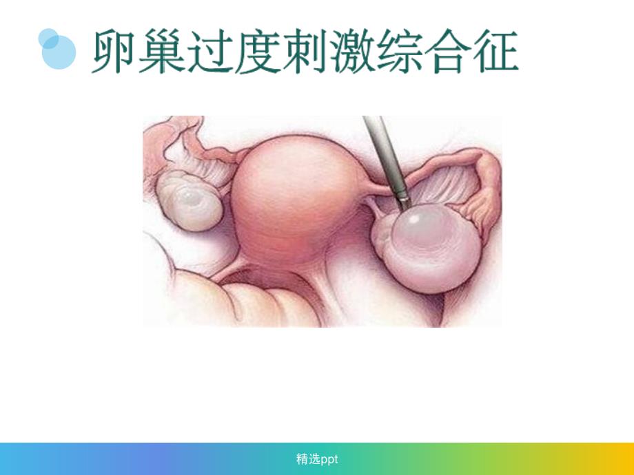 卵巢过度刺激综合征2_第2页