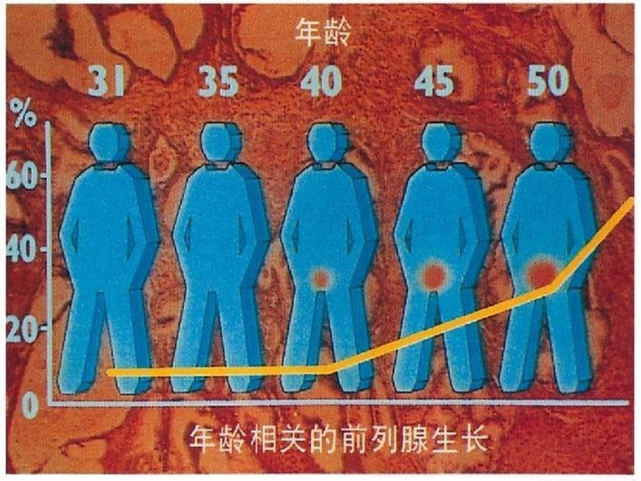 前列腺增生护理_第3页