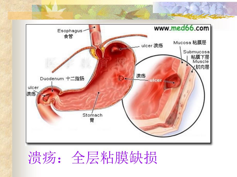 《胃十二指肠疾病病人的护理》PPT课件_第3页