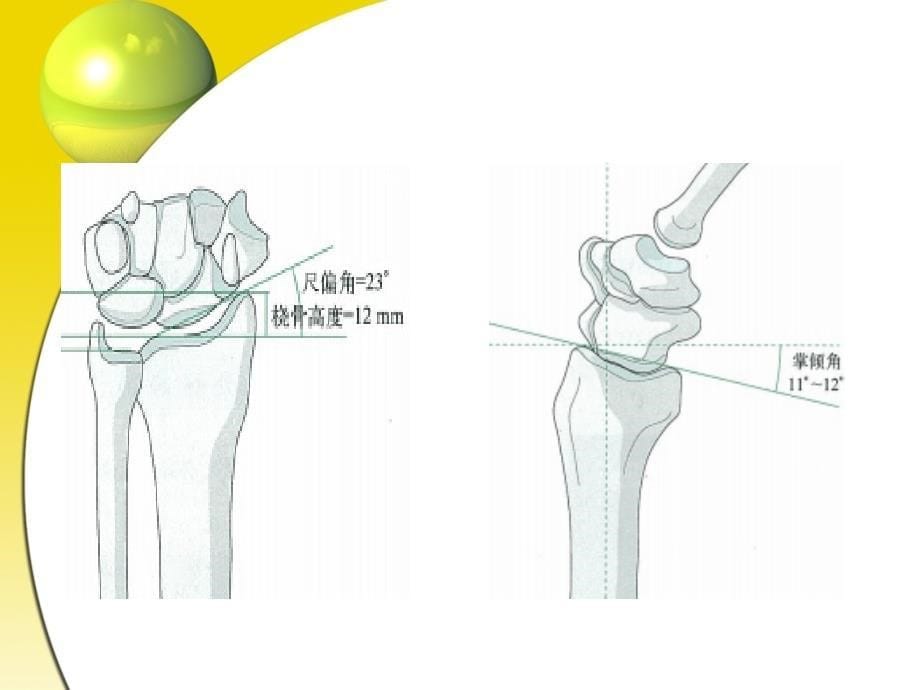 尺桡骨远端骨折的分型和治疗_第5页