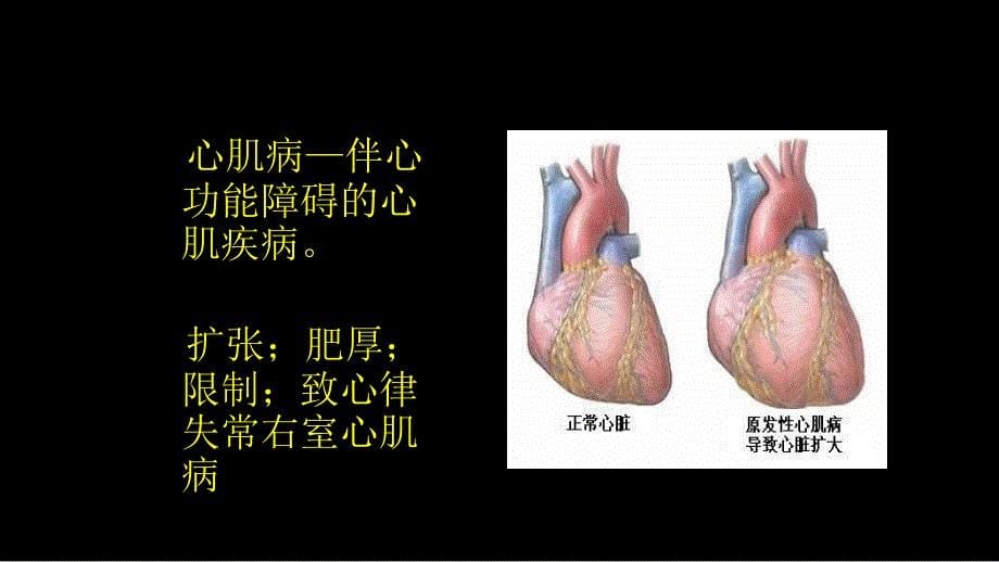 原发性心肌病讲座_第5页