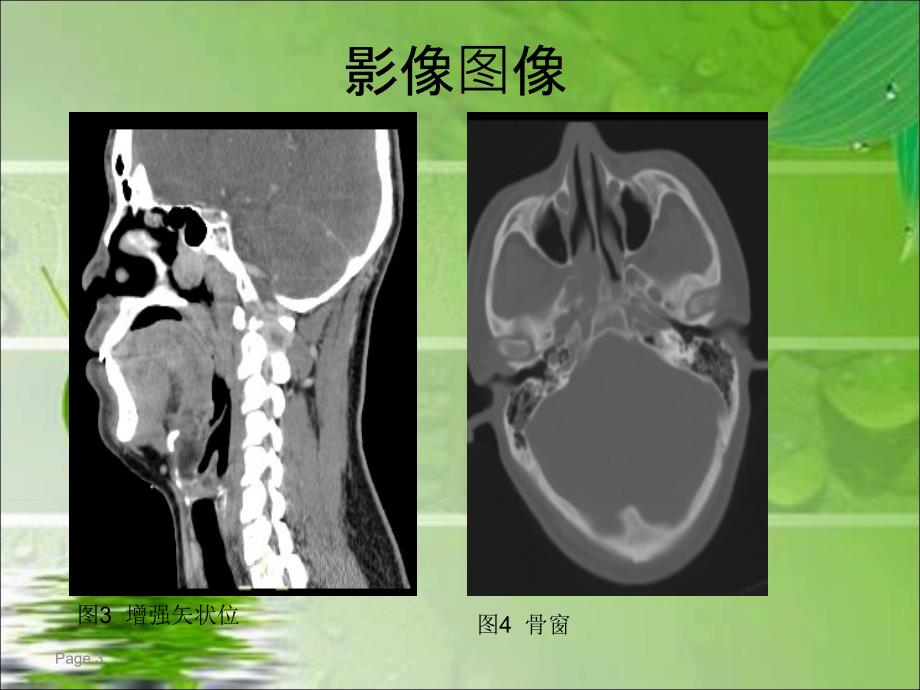 鼻咽纤维血管瘤的影像表现及临床_第3页