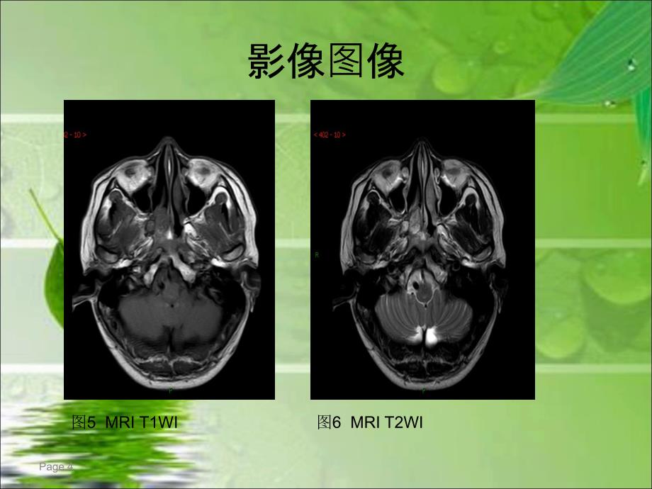 鼻咽纤维血管瘤的影像表现及临床_第4页