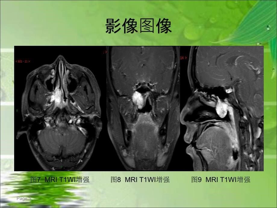 鼻咽纤维血管瘤的影像表现及临床_第5页