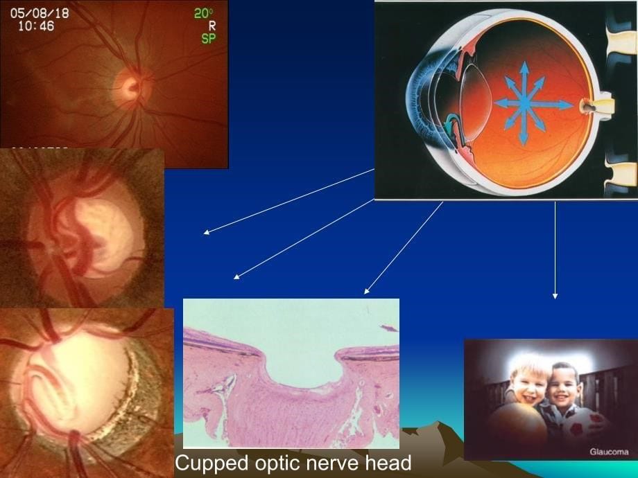 眼科学教学课件：青光眼_第5页