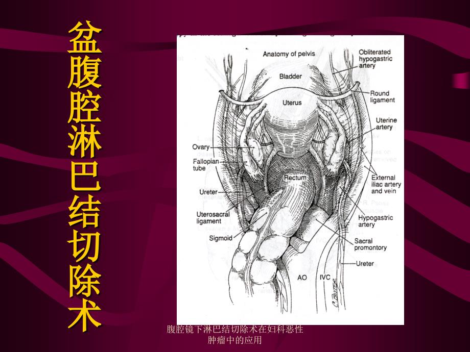 腹腔镜下淋巴结切除术在妇科恶性肿瘤中的应用课件_第2页