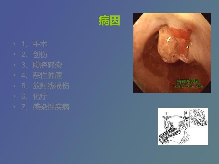 肠瘘的护理新进展_第5页